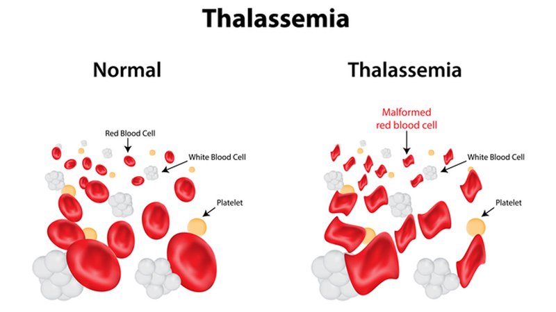 Thalassemia: Một dạng rối loạn về máu khiến trẻ không sử dụng được sản phẩm chứa nhiều sắt